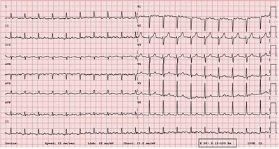 Case Report: Ethanol ablation of the Marshall vein as the first step for left atrial tachycardia ablation